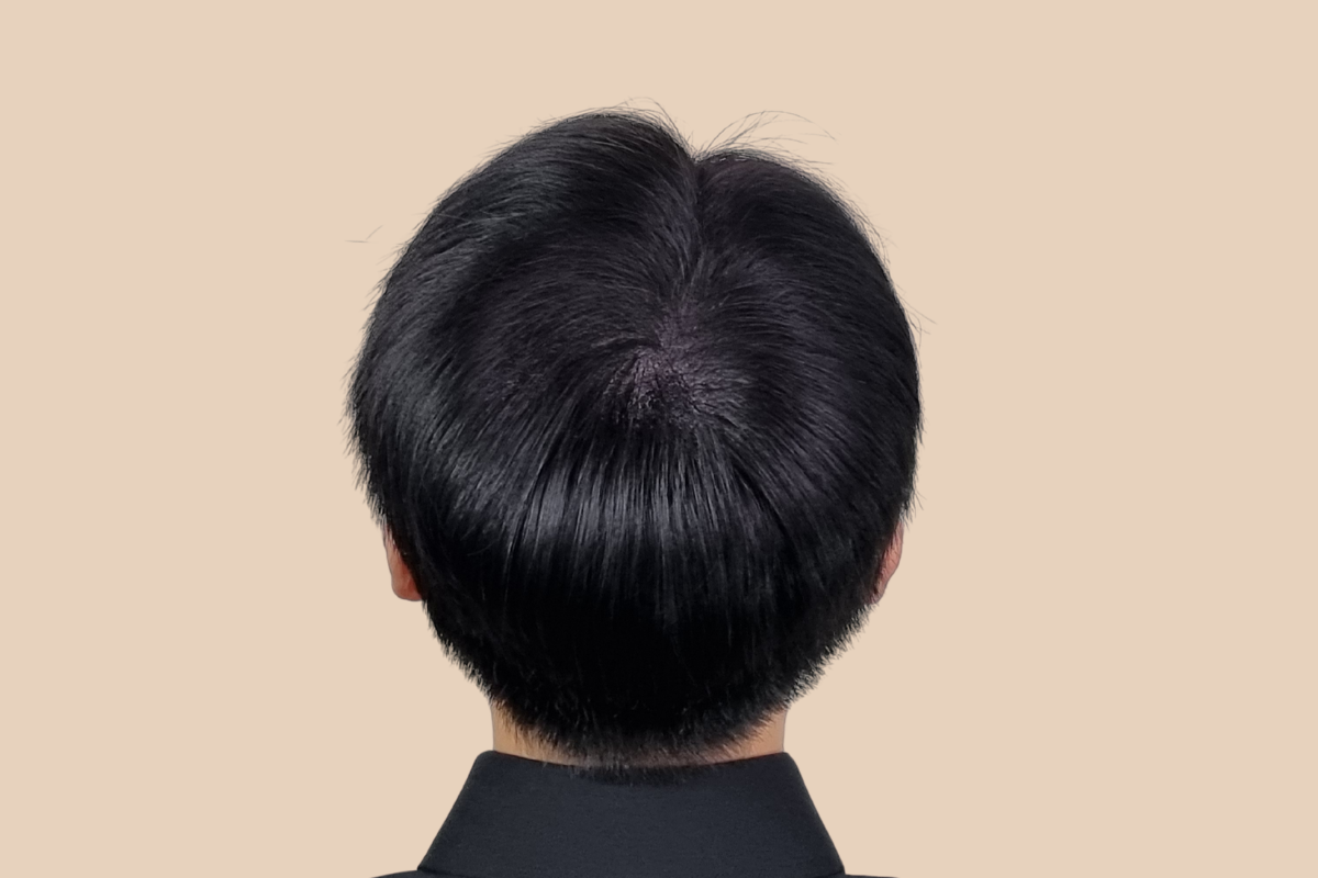 가르마 · 정수리 5회 시술 후