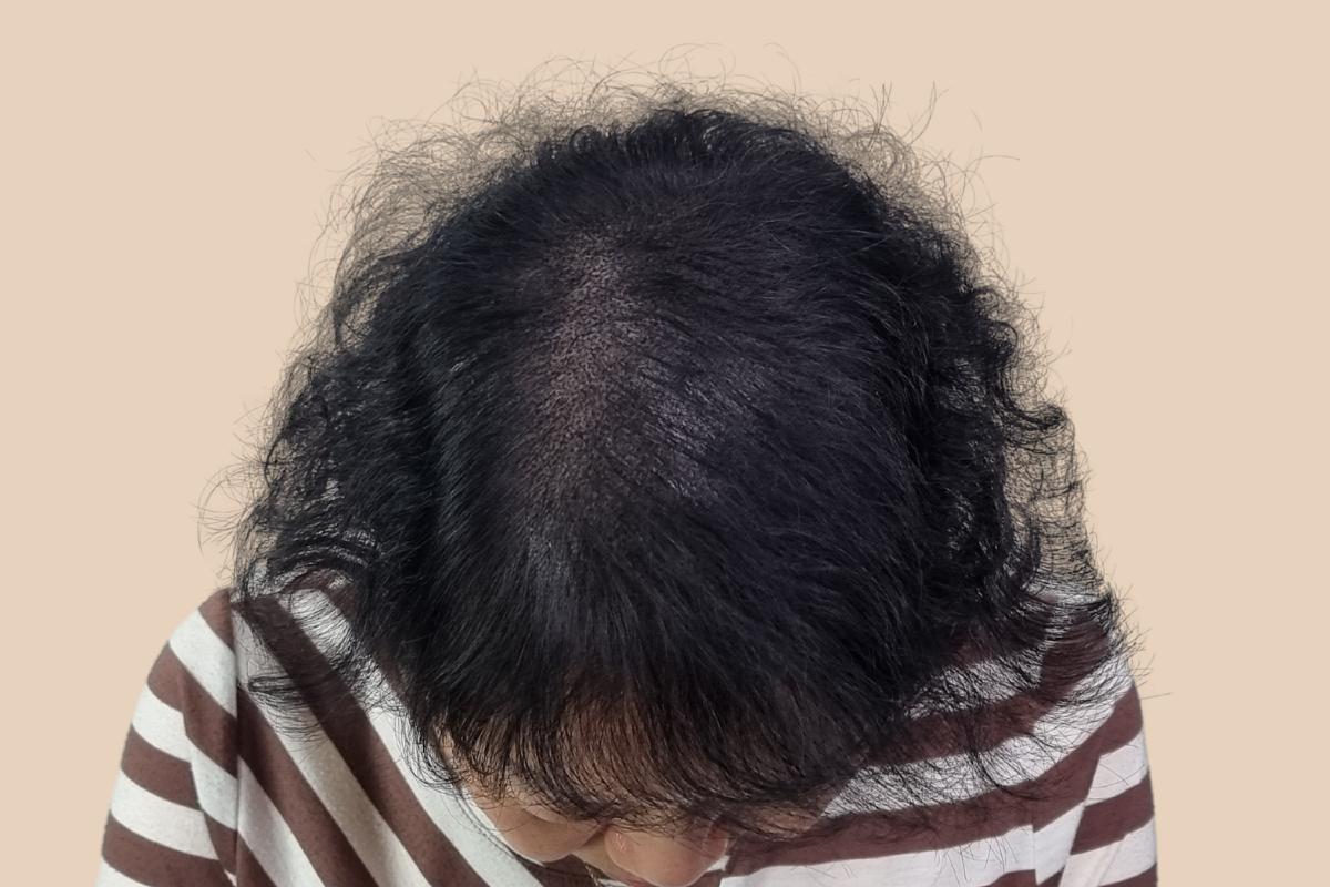 가르마 · 정수리 4회 시술 후