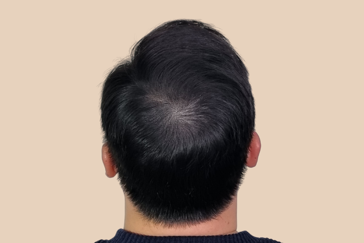 가르마 · 정수리 3회 시술 후