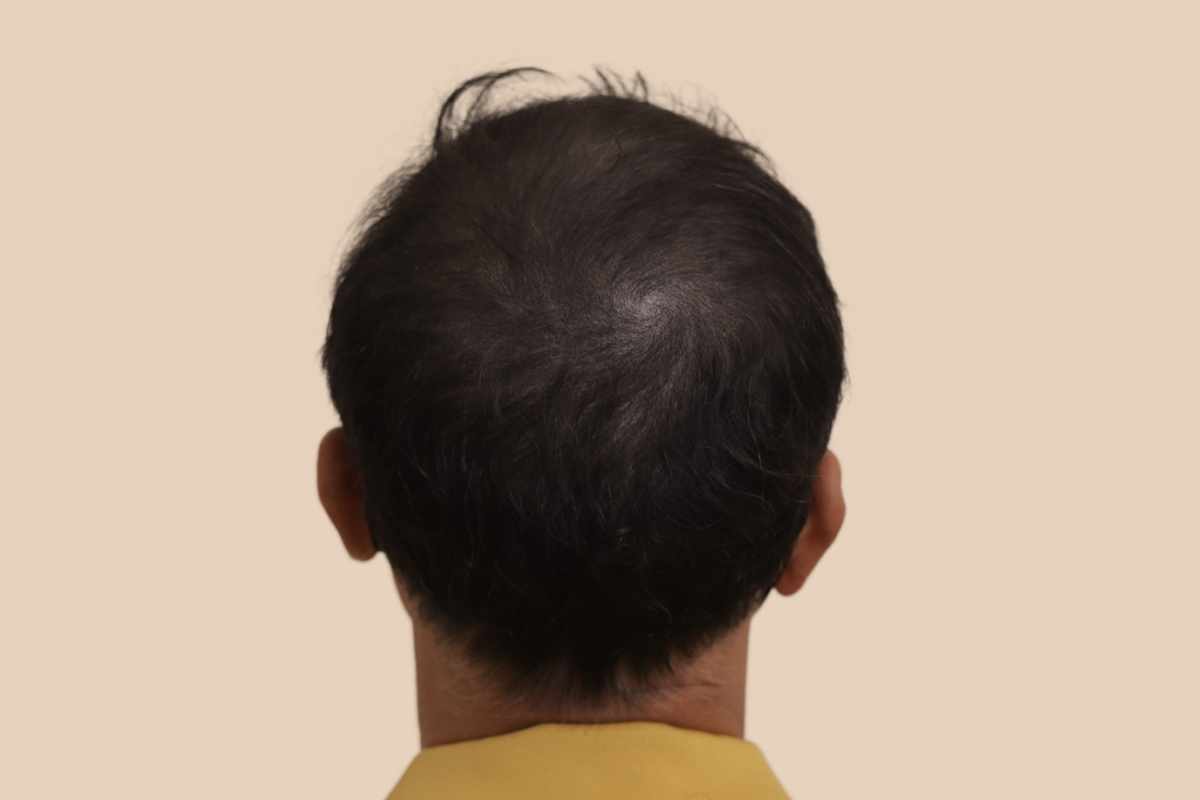 가르마 · 정수리 5회 시술 후