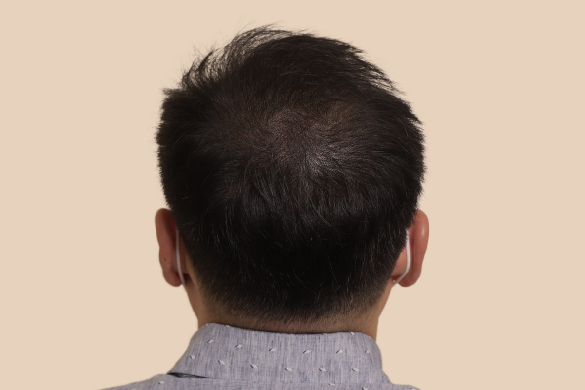 가르마 · 정수리 4회 시술 후