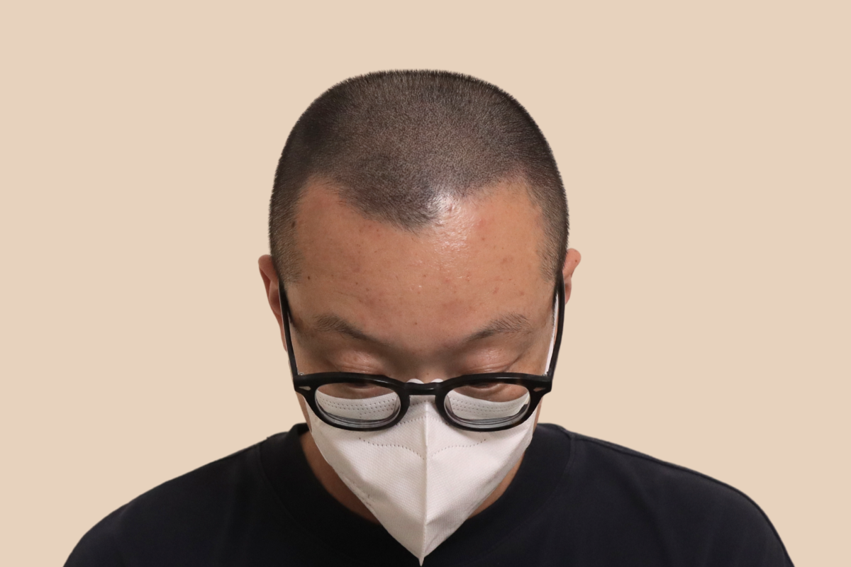 가르마 · 정수리 5회 시술 후