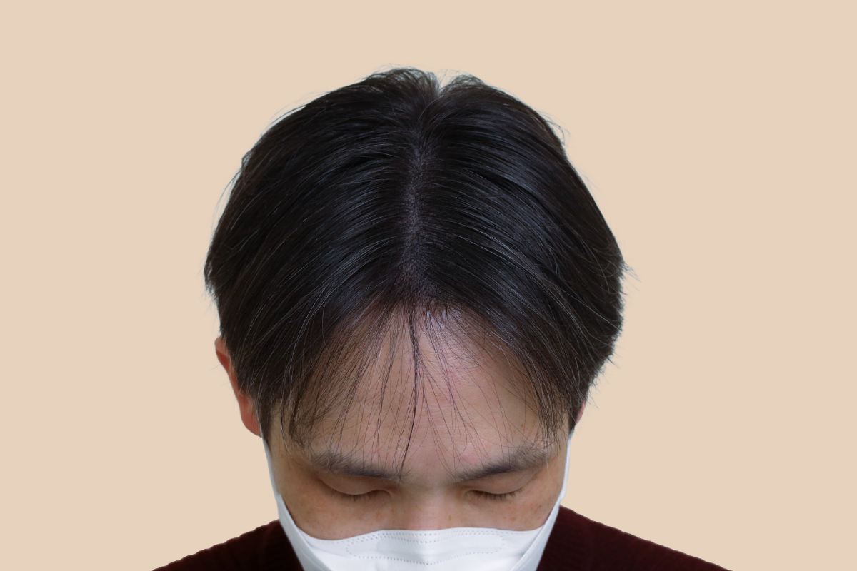 가르마 · 정수리 3회 시술 후