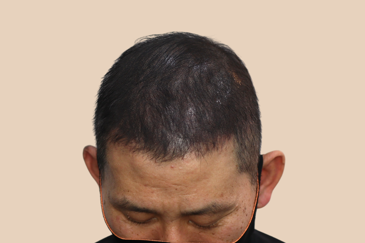 가르마 · 정수리 4회 시술 후