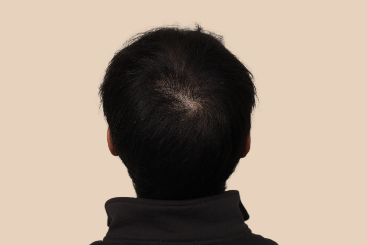 가르마 · 정수리 시술 전