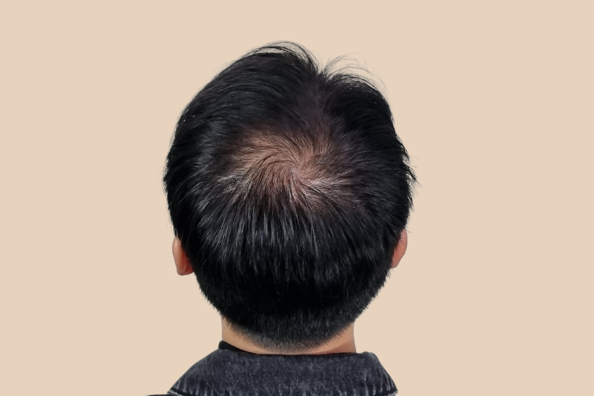 가르마 · 정수리 시술 전
