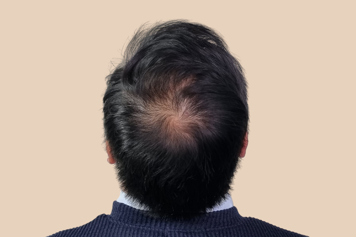 가르마 · 정수리 시술 전