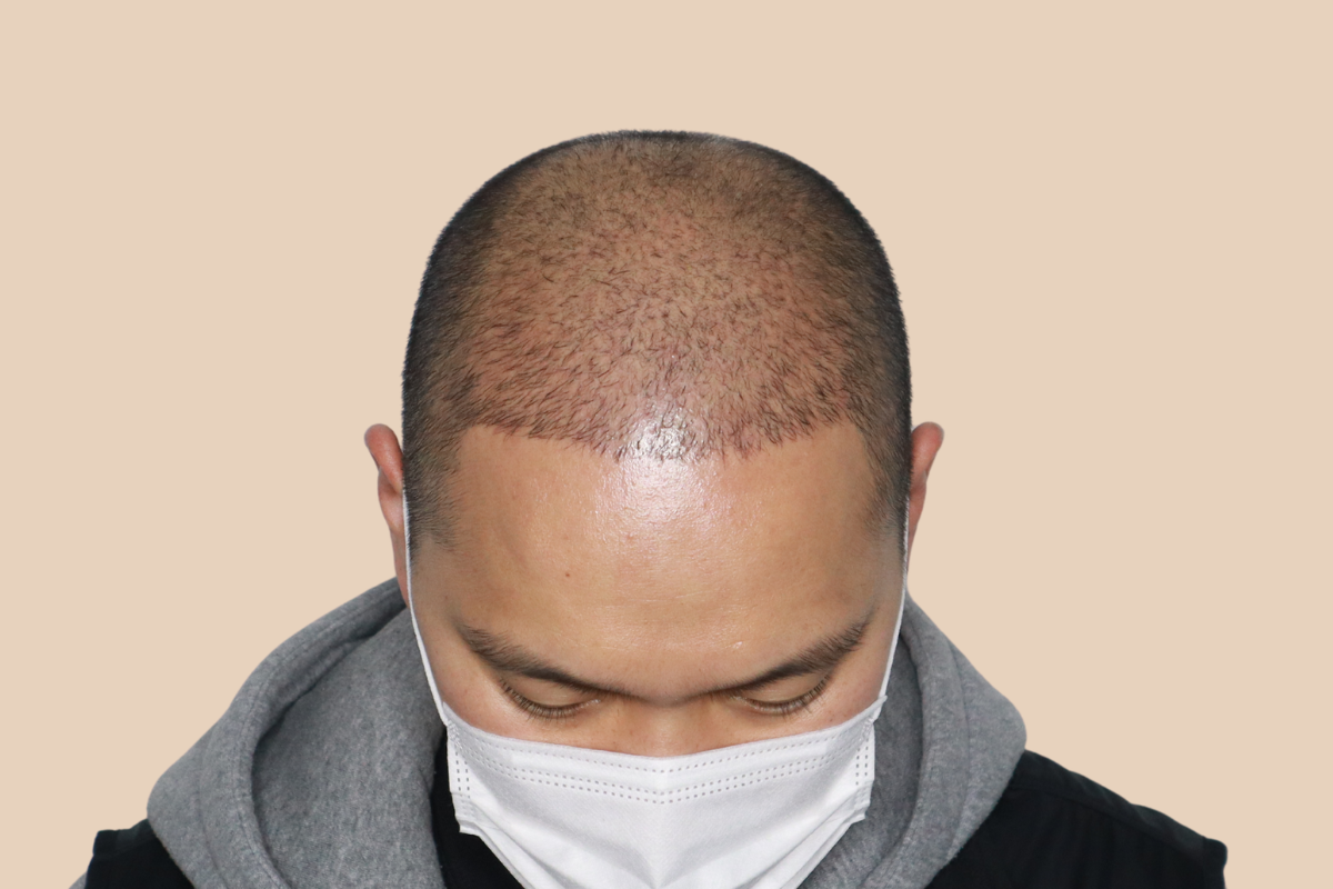 가르마 · 정수리 시술 전