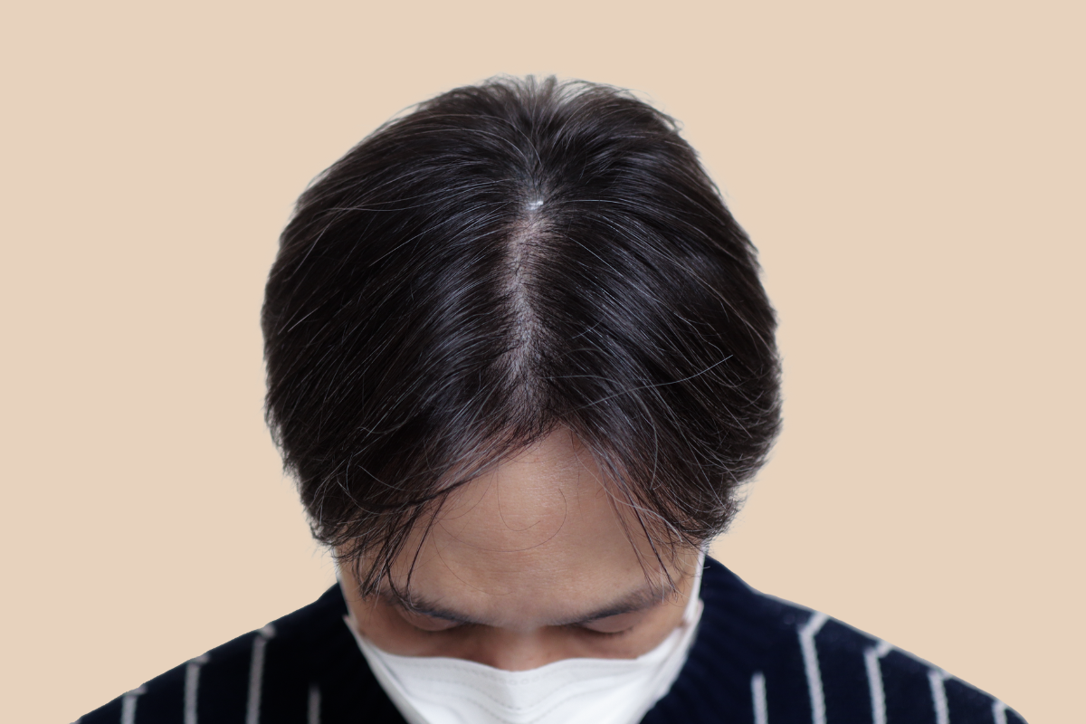 가르마 · 정수리 시술 전