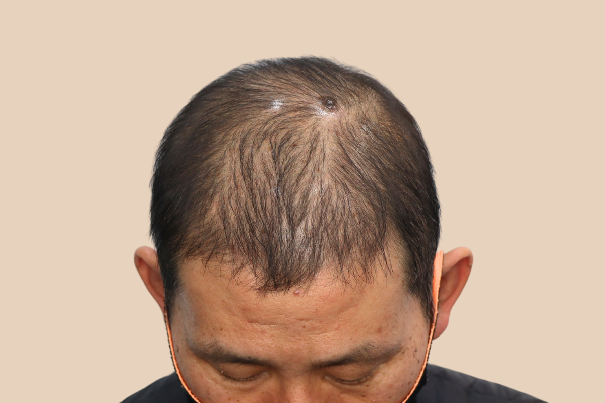 가르마 · 정수리 시술 전