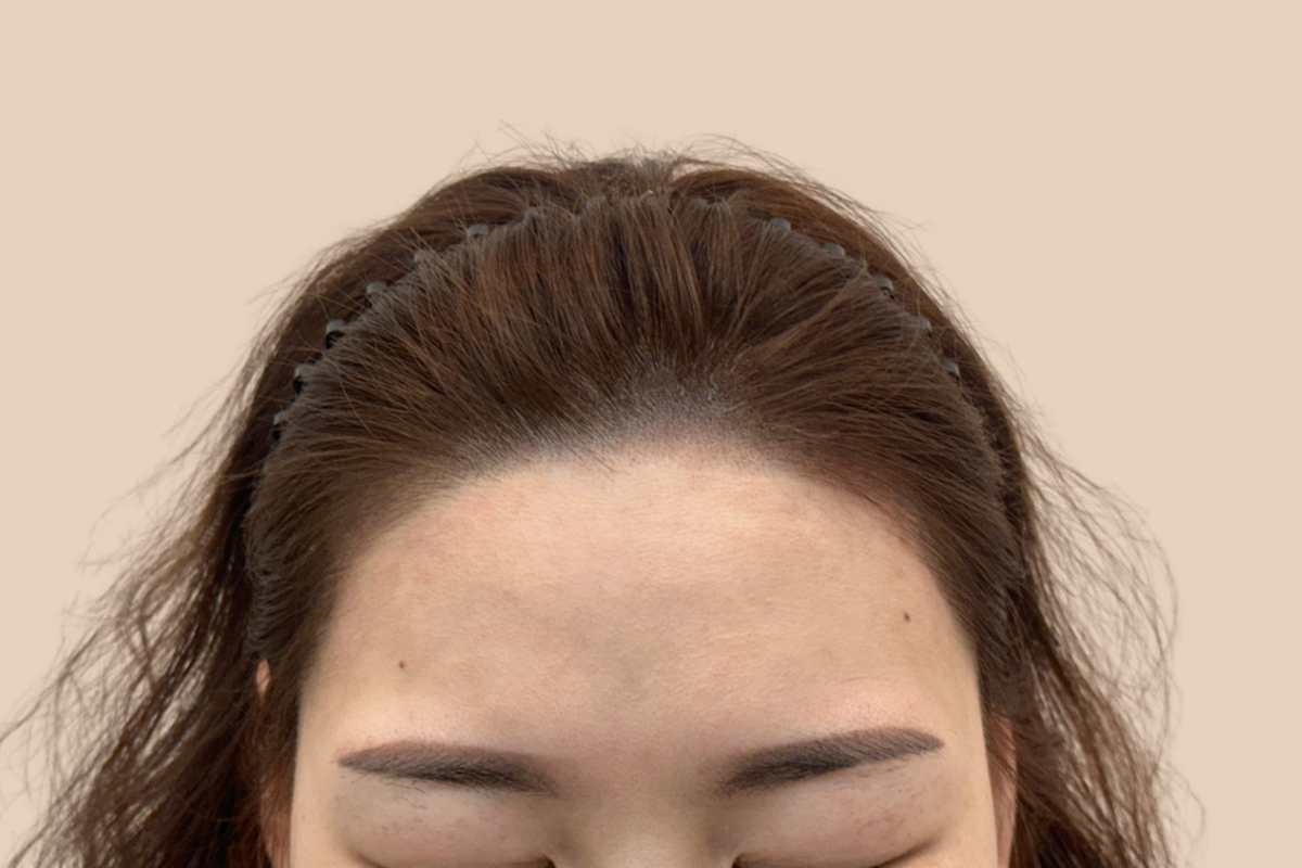 헤어라인 시술 후