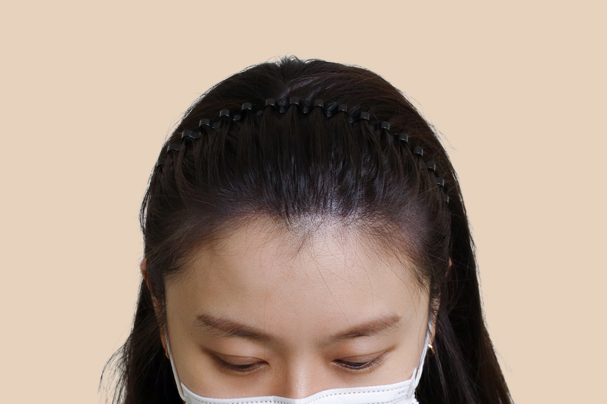 헤어라인 3회 시술 후