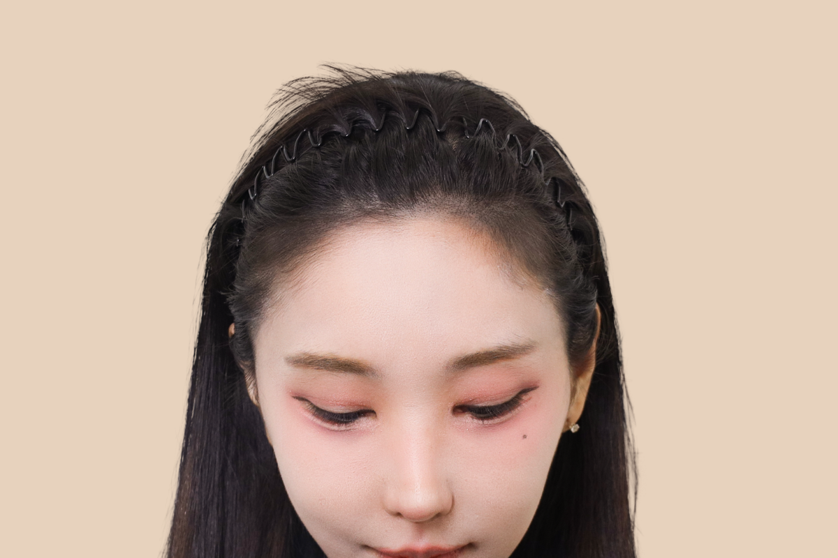 헤어라인 3회 시술 후