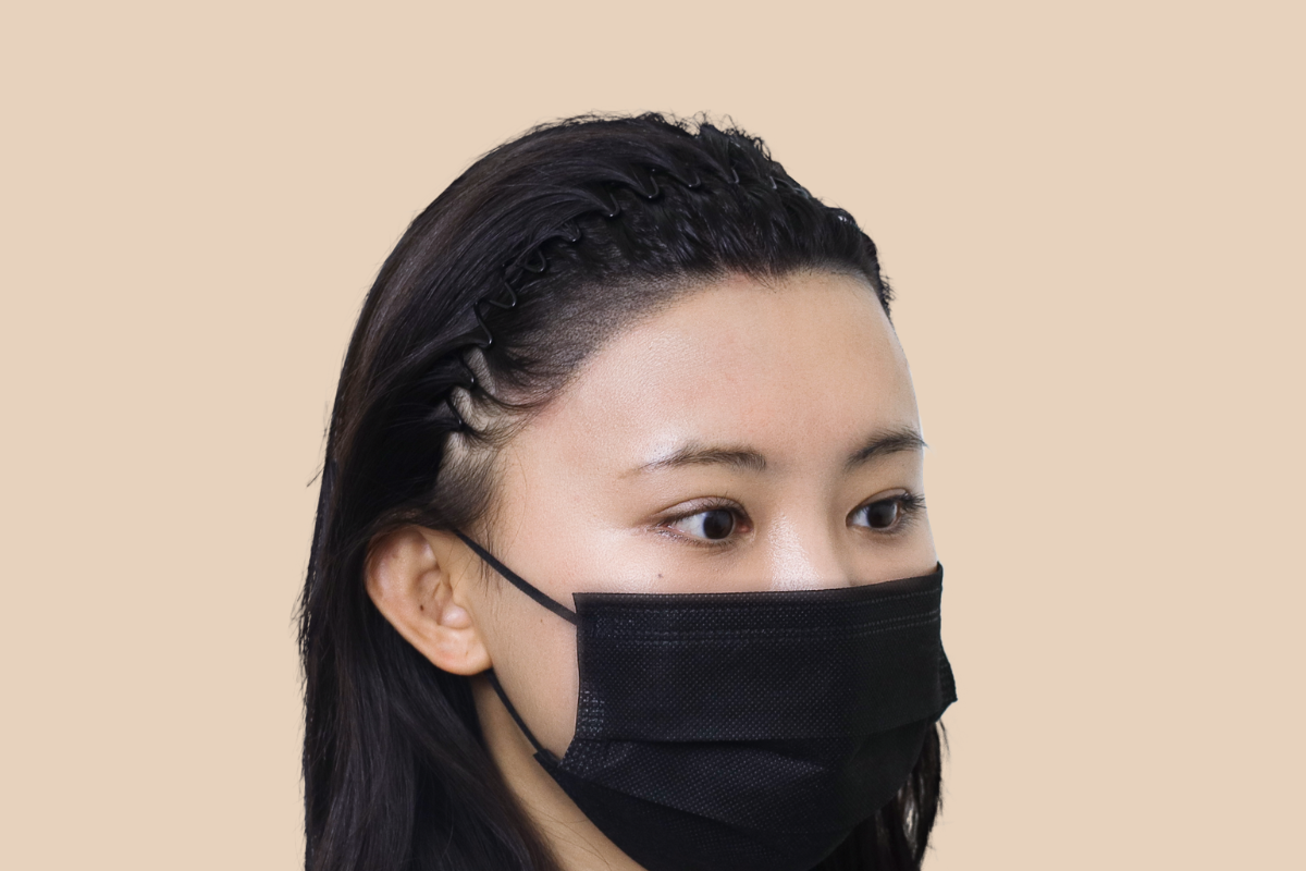 헤어라인 3회 시술 후