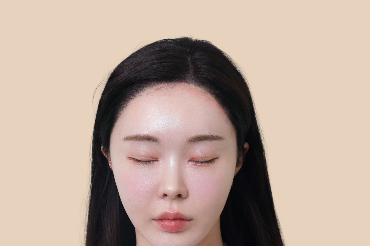 헤어라인 3회 시술 후