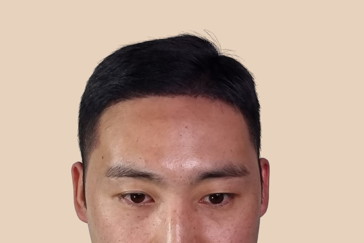 헤어라인 3회 시술 후