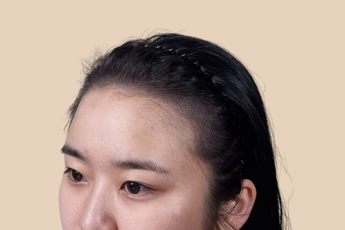 헤어라인 3회 시술 후