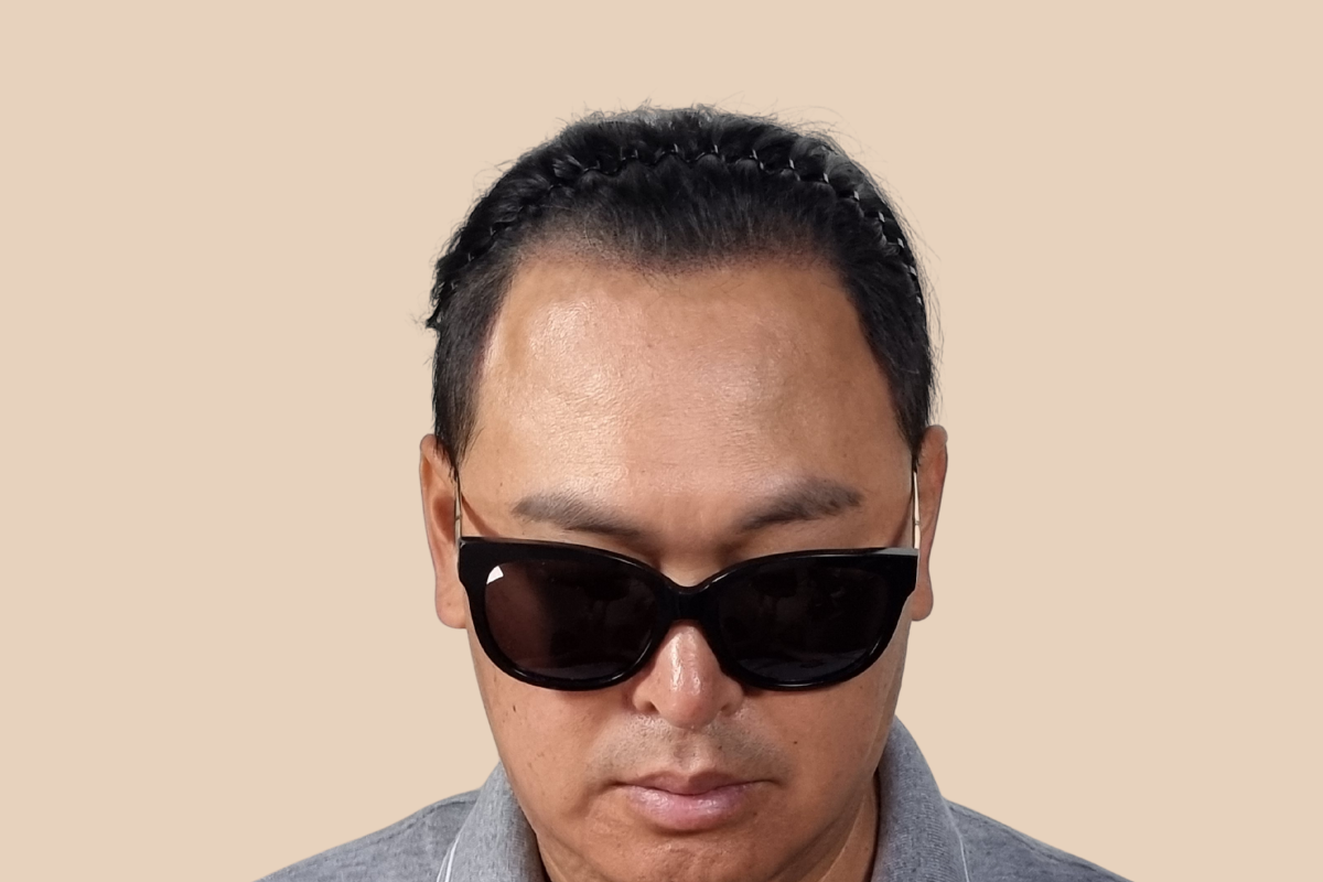 헤어라인 3회 시술 후