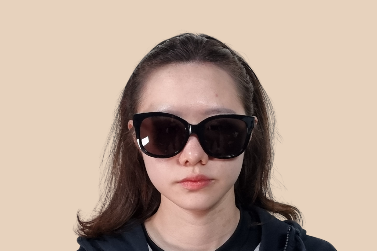 헤어라인 3회 시술 후