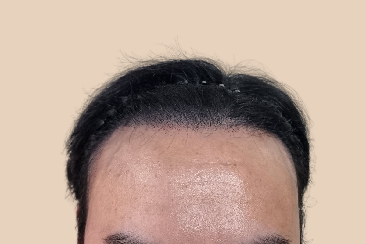 헤어라인 3회 시술 후