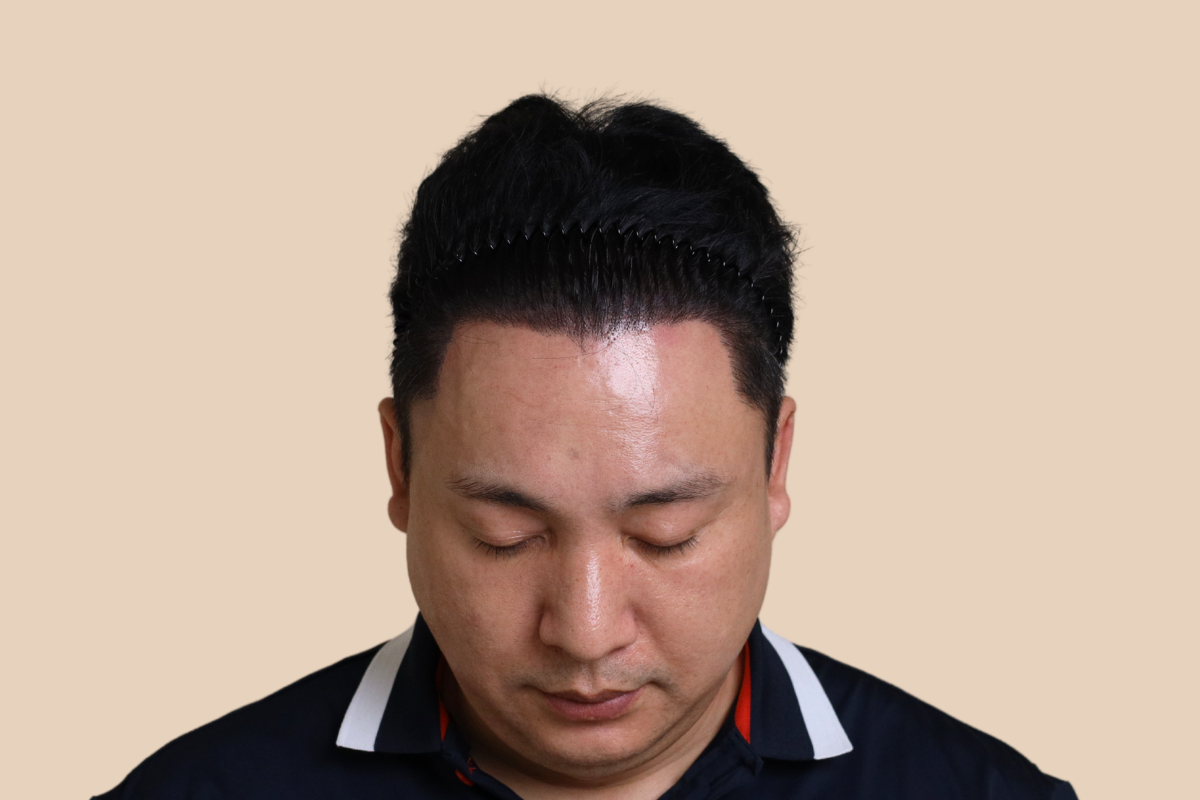 헤어라인 3회 시술 후