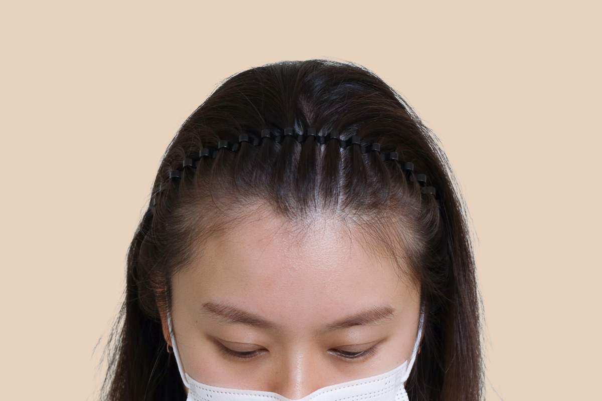 헤어라인 시술 전