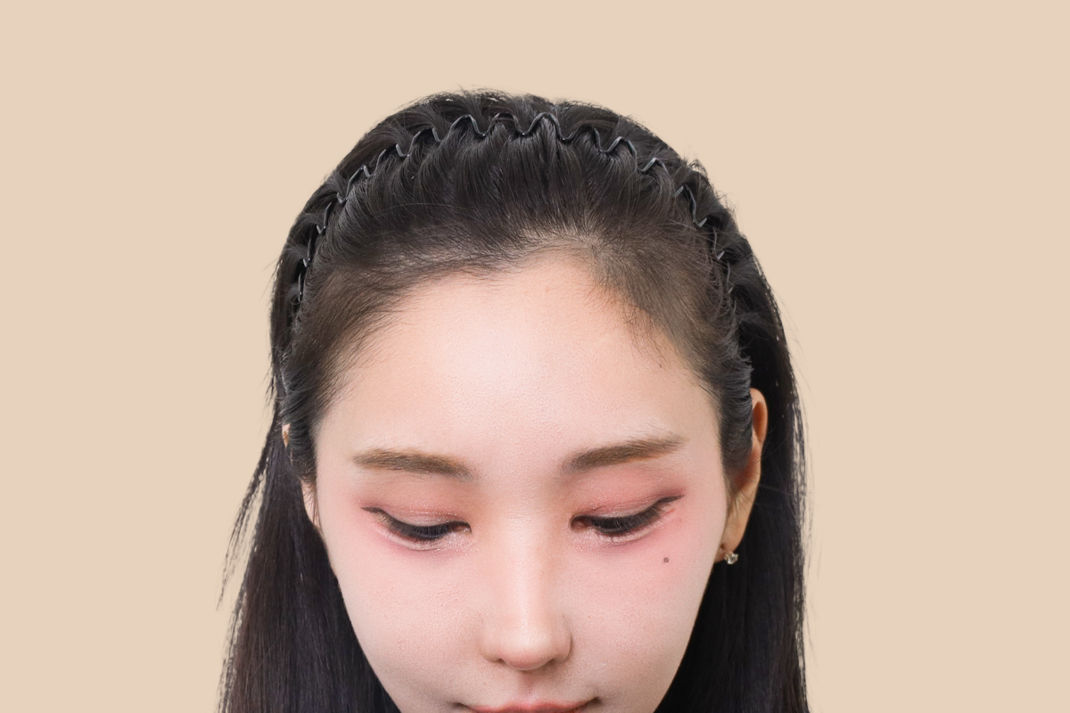 헤어라인 시술 전