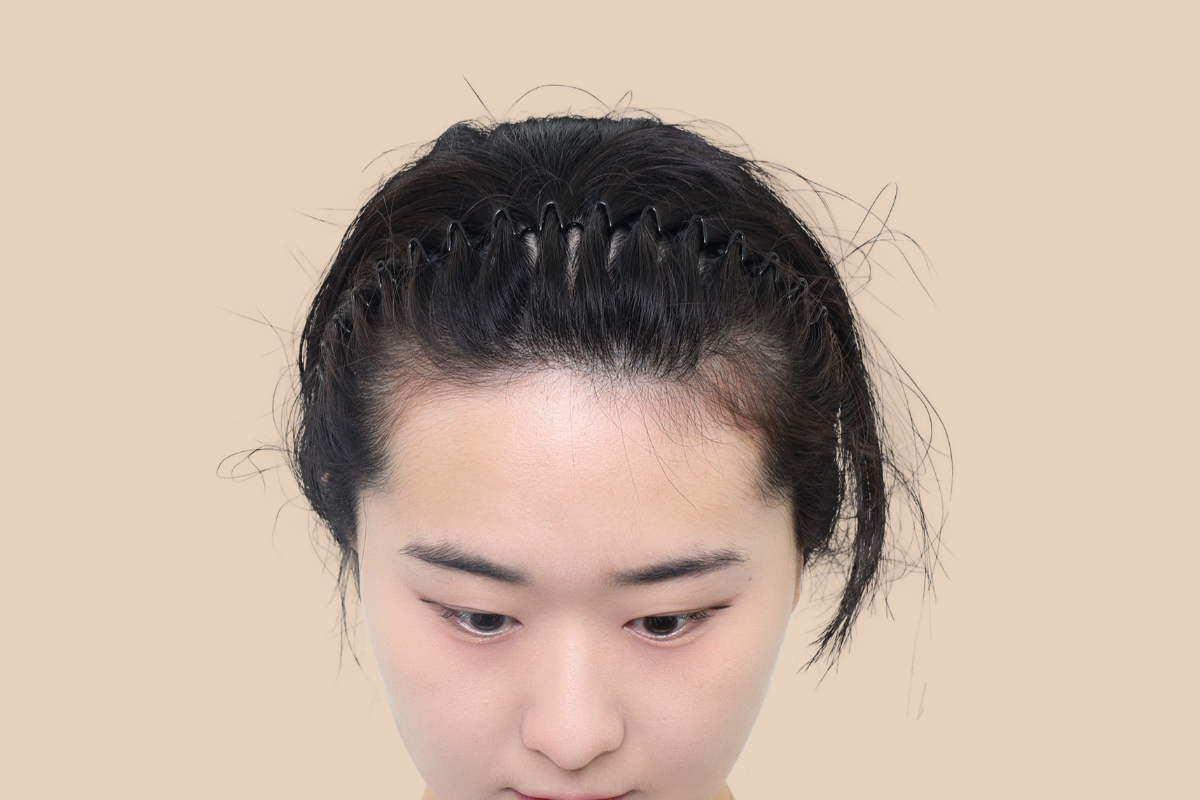 헤어라인 시술 전
