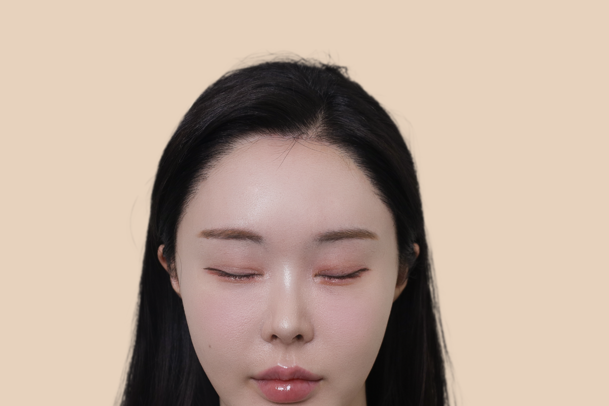 헤어라인 시술 전