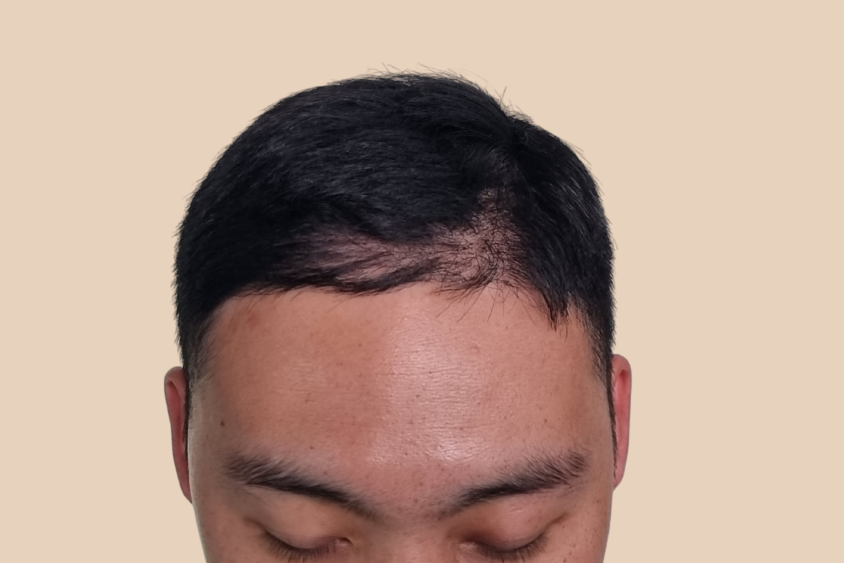 헤어라인 시술 전