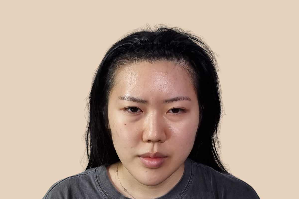 헤어라인 시술 전