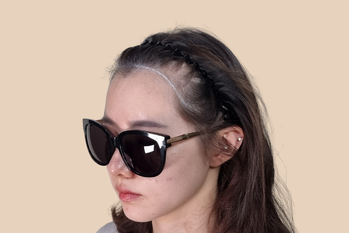 헤어라인 시술 전