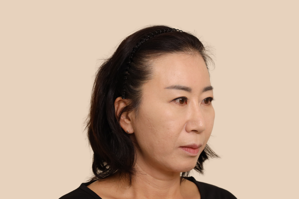 헤어라인 시술 전