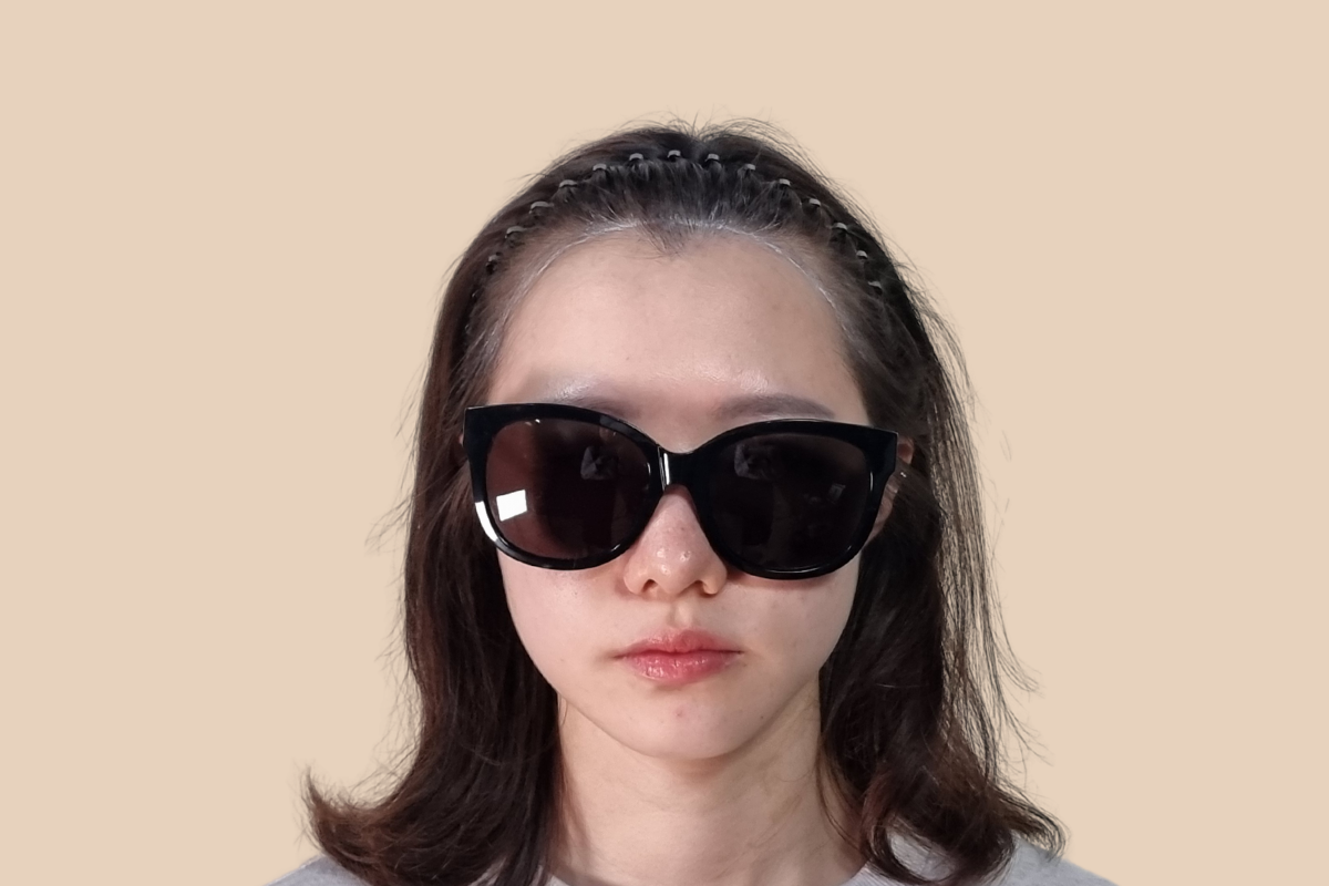 헤어라인 시술 전
