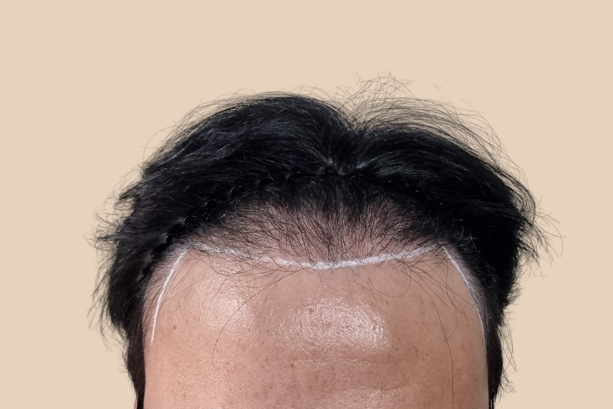 헤어라인 시술 전