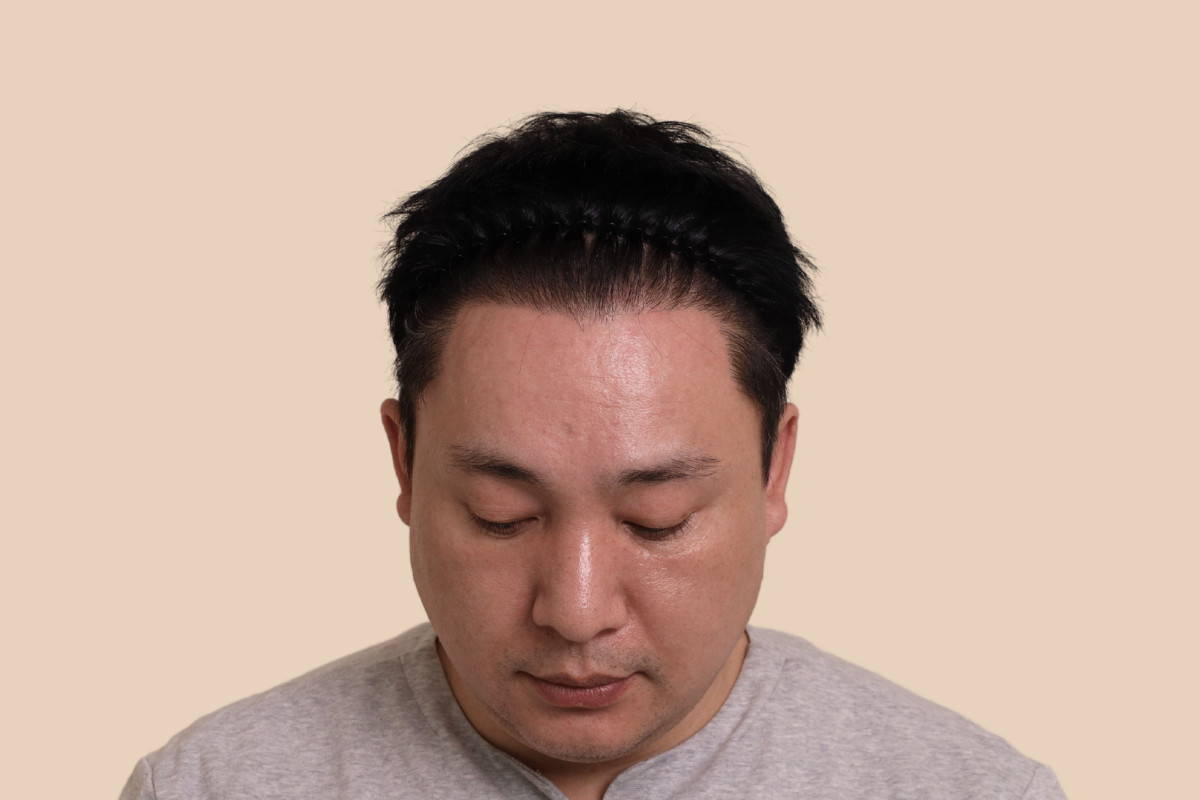 헤어라인 시술 전
