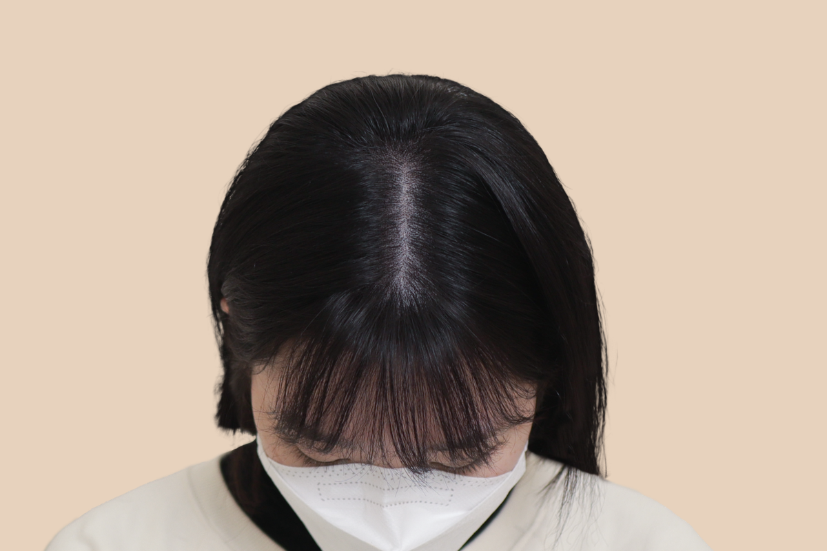 여성 두피문신 시술 후