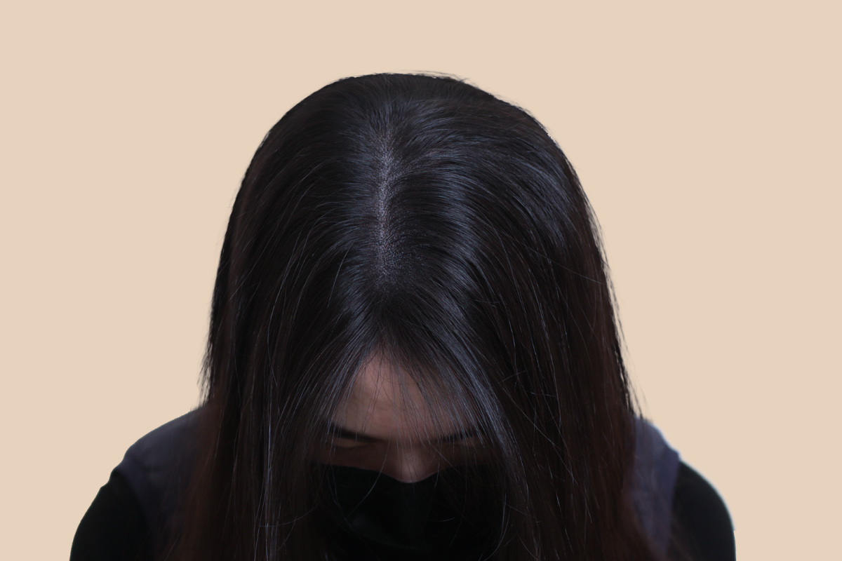 여성 두피문신 4회 시술 후