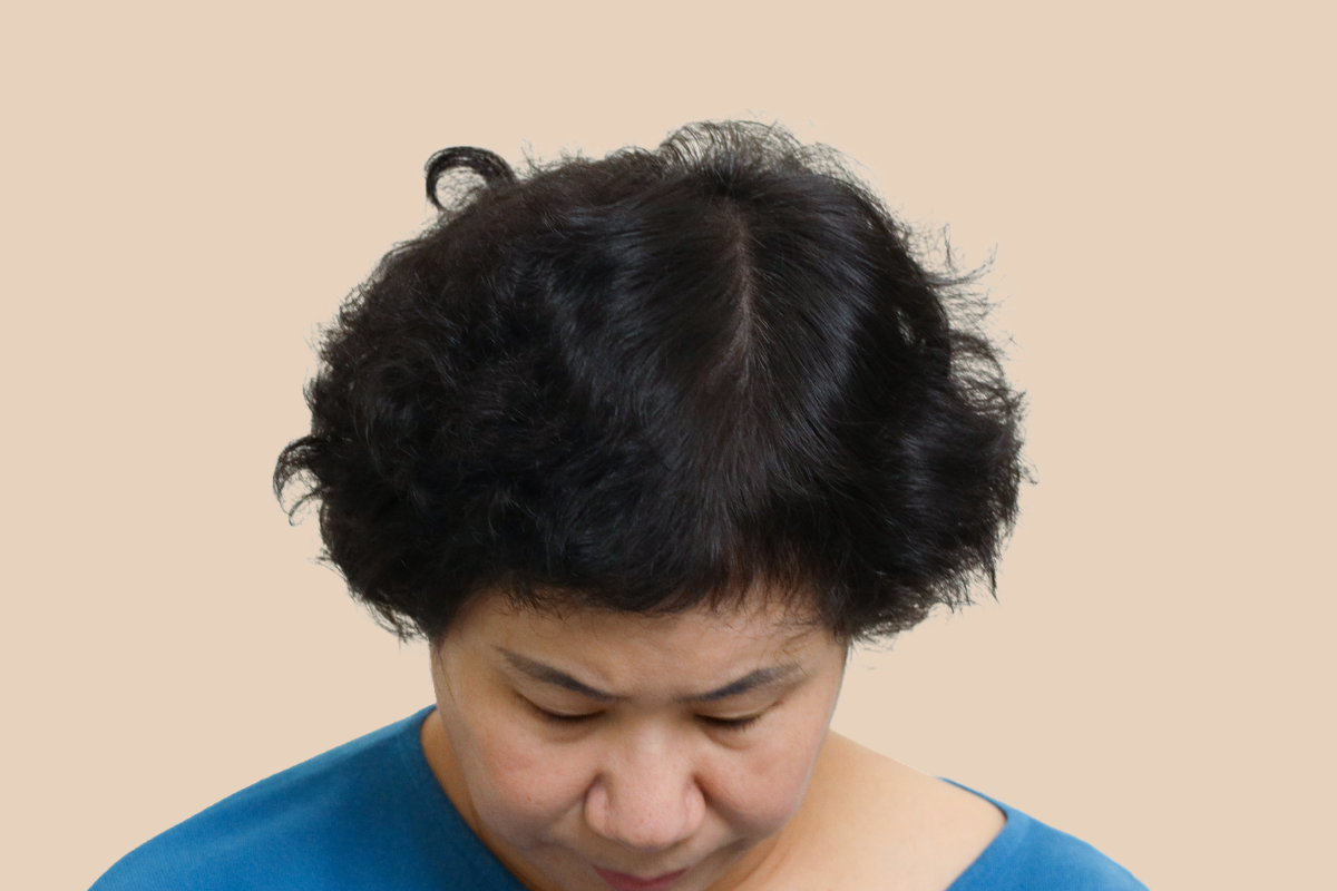 여성 두피문신 4회 시술 후