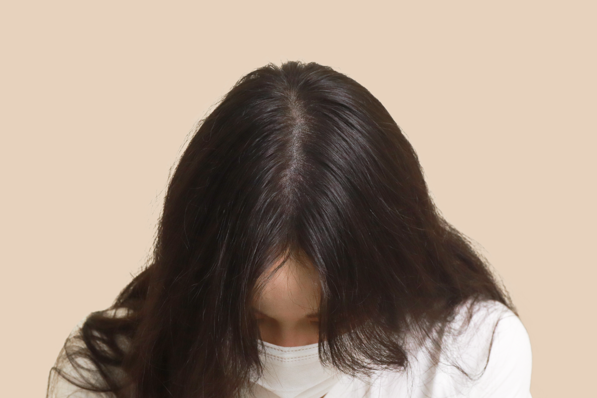 여성 두피문신 3회 시술 후