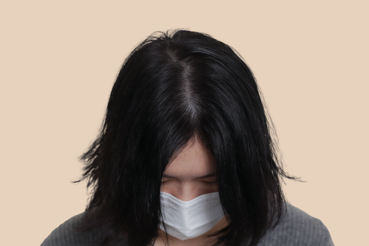 여성 두피문신 3회 시술 후