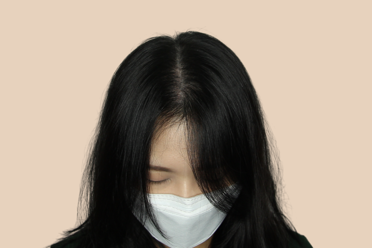 여성 두피문신 3회 시술 후