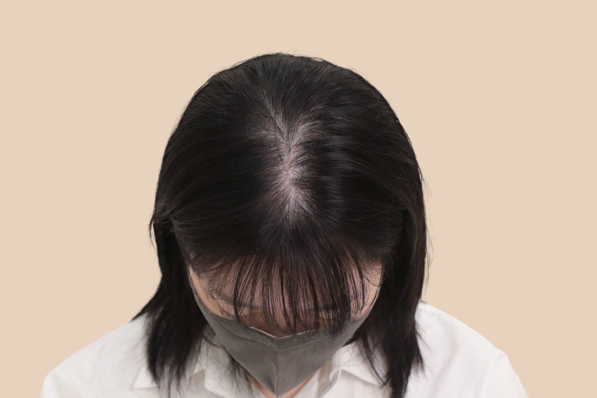 여성 두피문신 시술 전