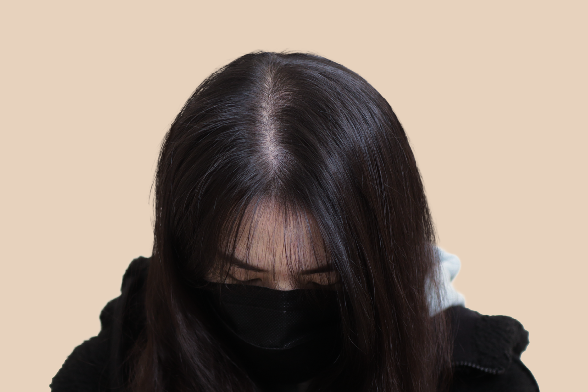 여성 두피문신 시술 전