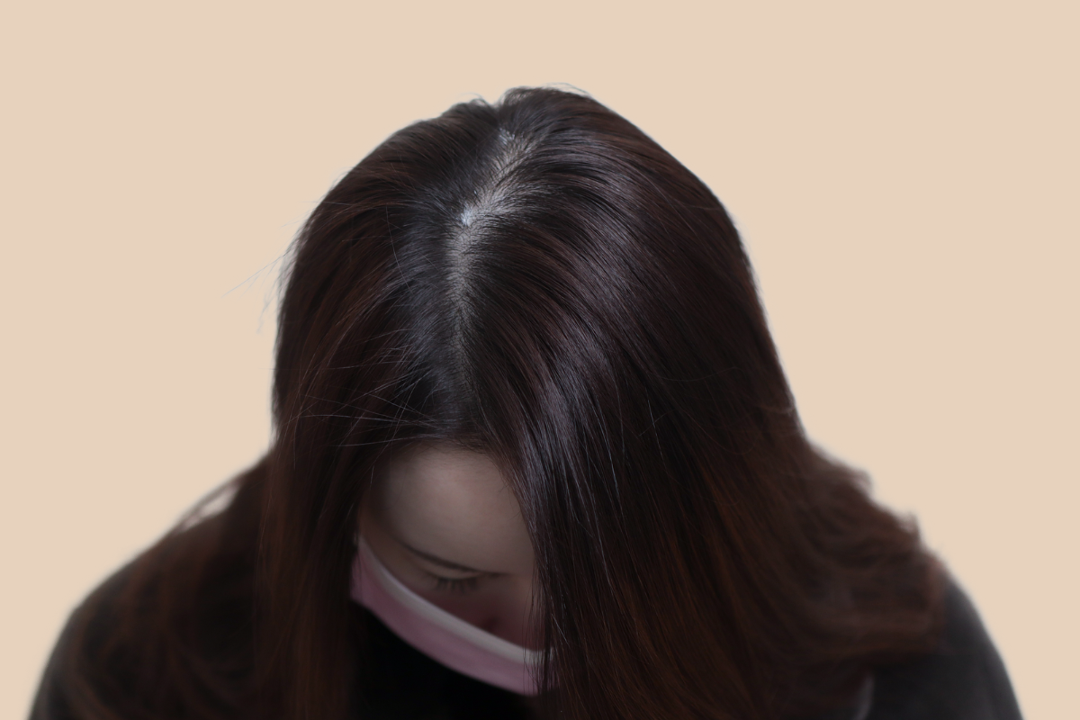 여성 두피문신 시술 전