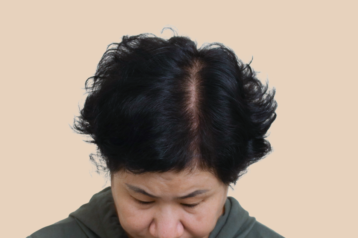 여성 두피문신 시술 전