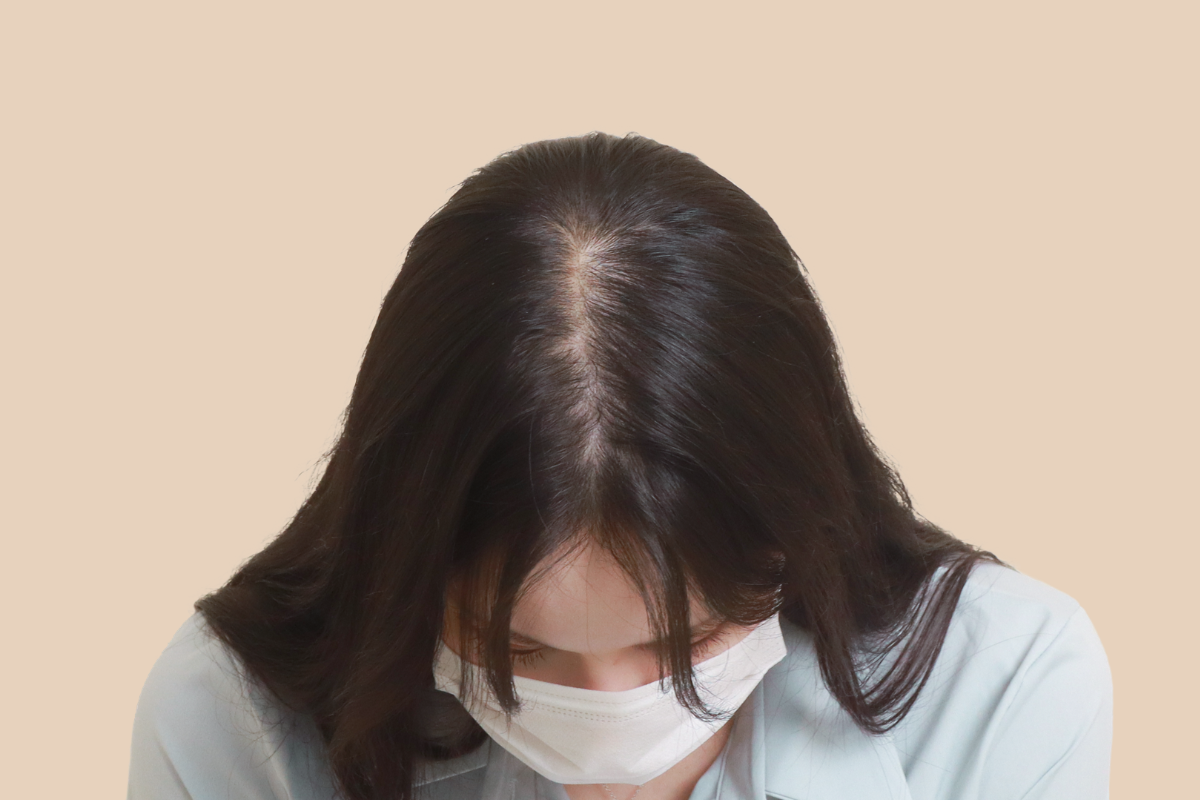 여성 두피문신 시술 전