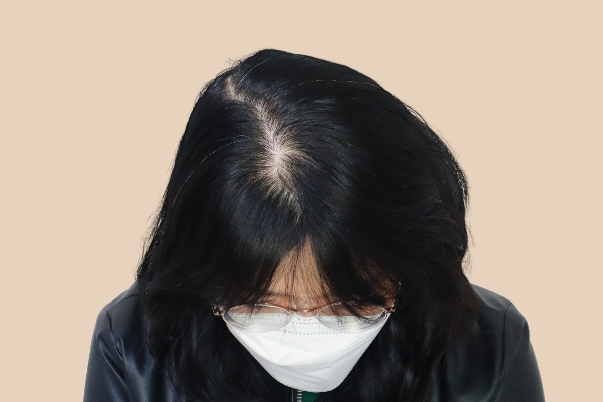 여성 두피문신 시술 전
