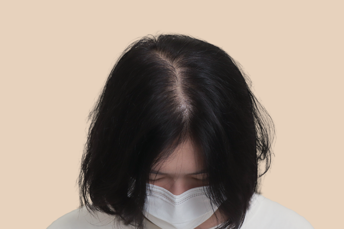 여성 두피문신 시술 전