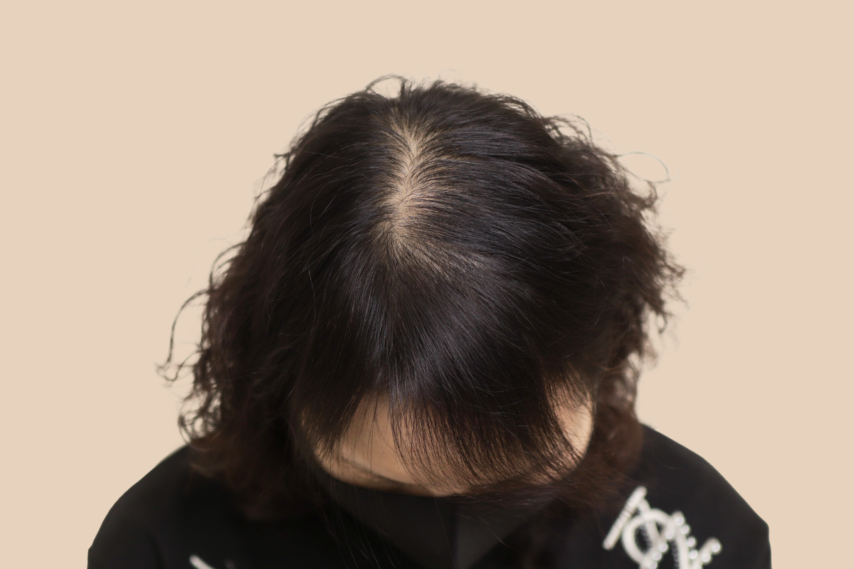 여성 두피문신 시술 전